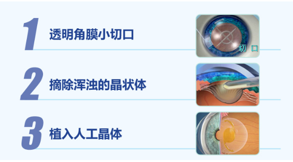 白內障手術